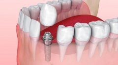口腔网：关于种植牙，你知道多少？
