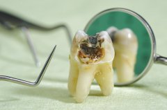牙科网分享：儿童龋齿护理方法大全