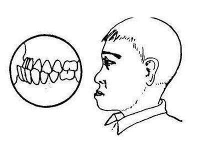 牙齿出现地包天几岁矫正效果好