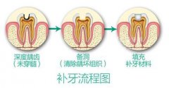 重庆诚嘉口腔医院介绍补牙材料-复合树脂