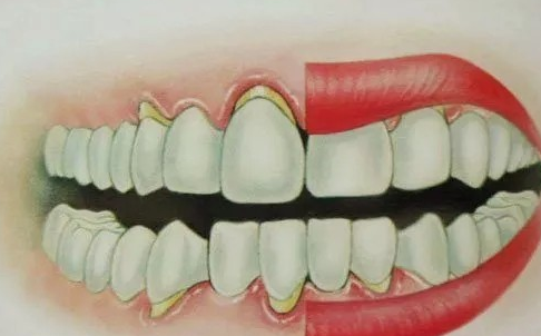 牙龈天天在萎缩！牙龈萎缩了该怎么办？