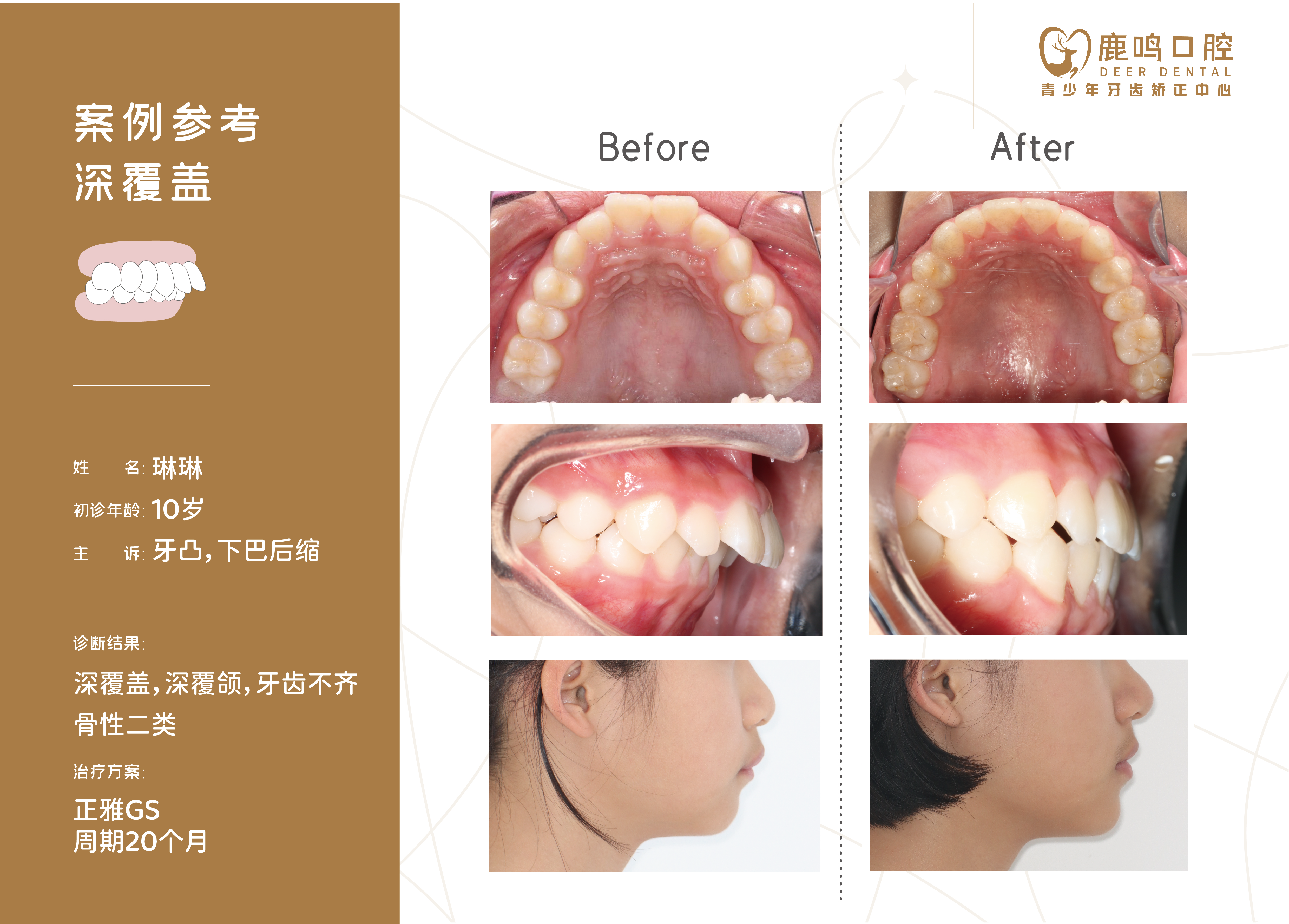 鹿鸣矫正案例2