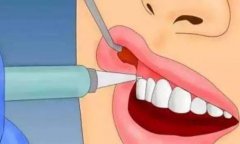 蛀牙到牙髓了，为什么医生不让杀牙髓?