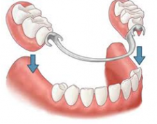 牙齿缺损、缺失以及牙齿不美观修复方式有哪些？