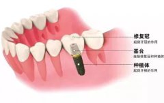“种植牙”凭什么能成为牙齿缺失最好的修复方式？