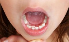 如何正确应对儿童牙齿畸形？
