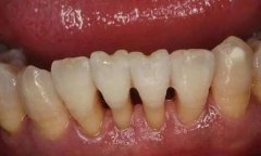 牙龈萎缩是什么原因造成的？