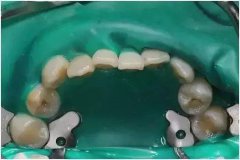 牙医：使用橡皮障有什么优点？