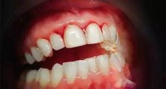 调查数据显示牙龈癌多见于中老年人